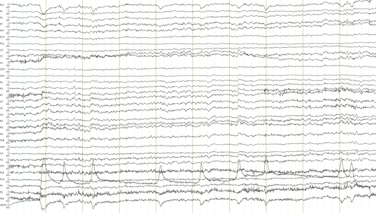 eeg waves